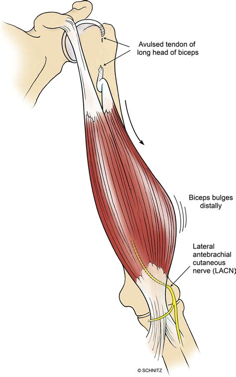 Medial Brachial Cutaneous Nerve