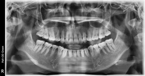 How Much Radiation is there in a Dental X-Ray?