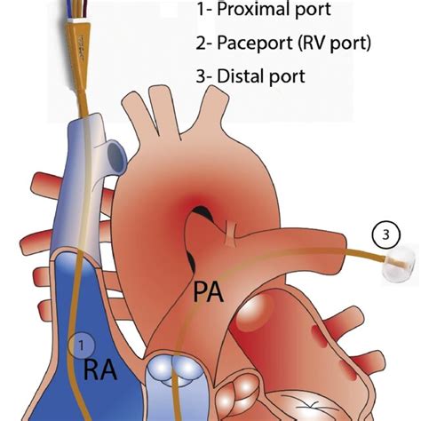 Pulmonary Artery Catheter