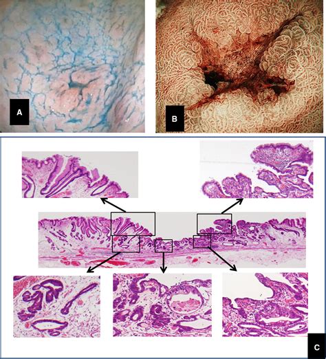 Prevention Of Gastric Cancer By Helicobacter Pylori Eradication A