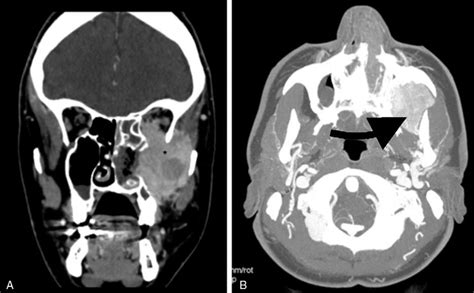 Computed Tomography Ct Scan Showing A Left Nasal Cavity Mass Download Scientific Diagram