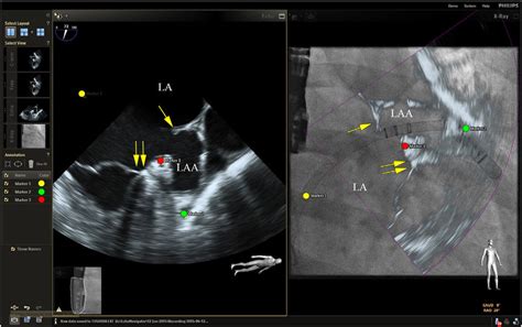 Fusion Imaging For Laa Occlusion Left Tee With Coumadin Ridge Yellow