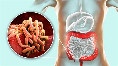 Enterobijaza Uzrok Simptomi Lije Enje