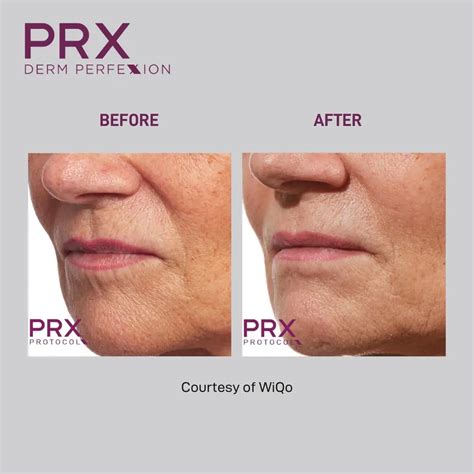 Prx Derm Perfexion Riverchase Dermatology