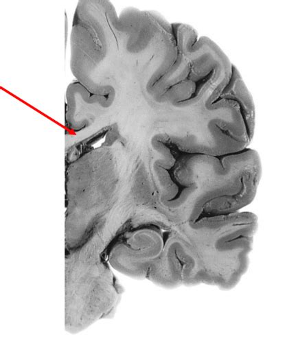 Neuroanatomy Coronal Sections Flashcards Quizlet