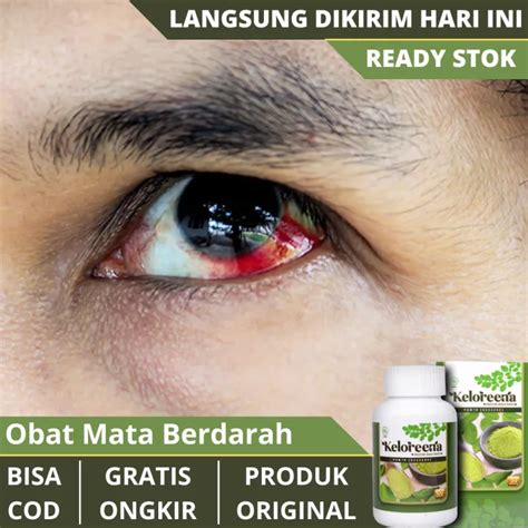 Obat Mata Merah Berdarah Obat Pembuluh Darah Pecah Bocor Keluar Darah