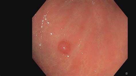 Intestinal Kaposi Sarcoma Endoscopy Campus