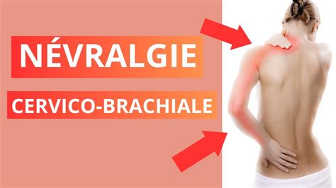 Névralgie Cervico Brachiale Causes Symptômes et Traitement YouTube