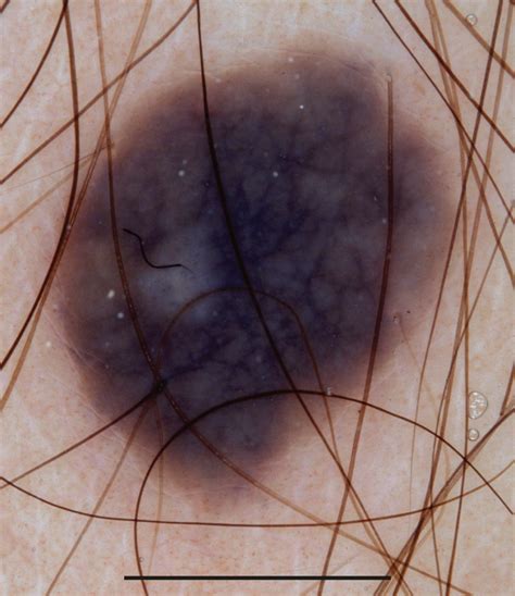 Dermoscopy Of Melanocytic Neoplasms Blue Nevi Dermatology Jama