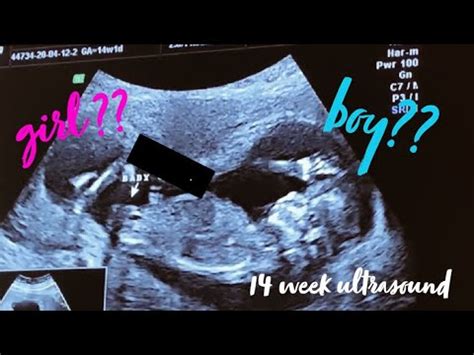 14 WEEK 3D ULTRASOUND GENDER REVEAL YouTube