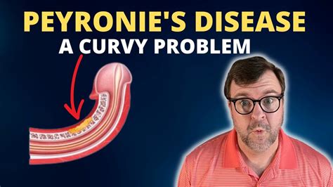 Peyronies Disease A Curvy Problem How To Fix A Curved Penis Dr Kent