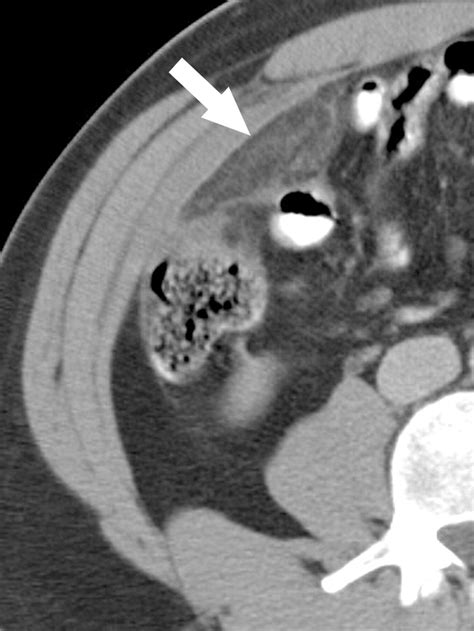 Acute Epiploic Appendagitis And Its Mimics Radiographics