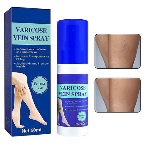 Spray Pour Varices Spray De Traitement Des Varices Pour Les Jambes