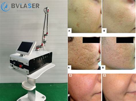 Equipo Rejuvenecimiento Facial Laser Co2 Fraccionado En Industria De La