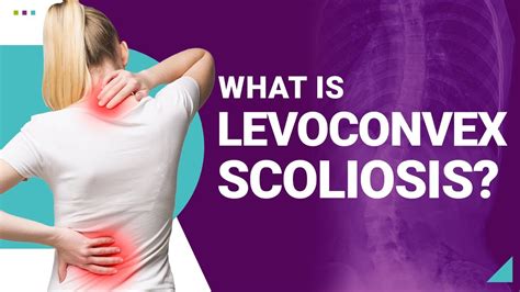 What Is Levoconvex Scoliosis YouTube