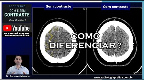 Como Saber Se A Tomografia De Cr Nio Foi Feita Ou Sem Contraste