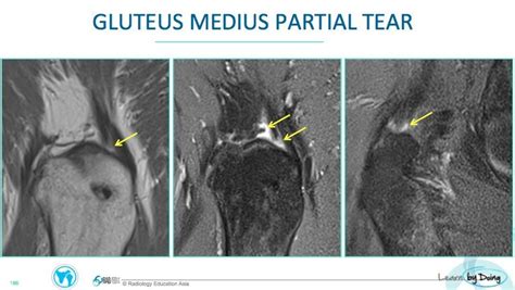 Gluteus Medius Tendon Tear