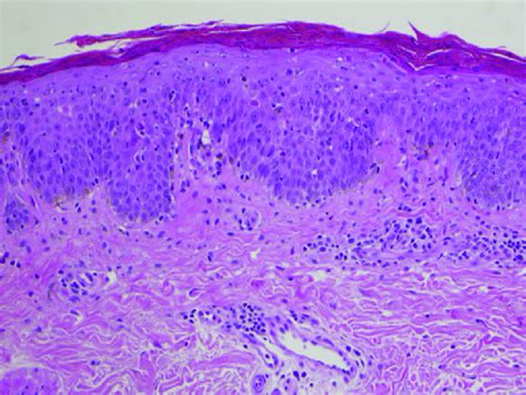 Skin Biopsy Showing Confluent Parakeratosis And Dyskeratotic