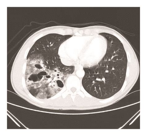 CT Scan Of The Chest Showing Thick Walled Multicystic Lesions With