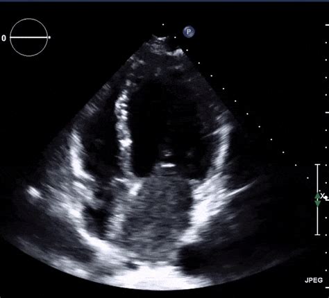 Chest Guidelines Lv Thrombus Literacy Basics