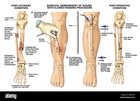 Tibia And Fibula Fracture Surgery