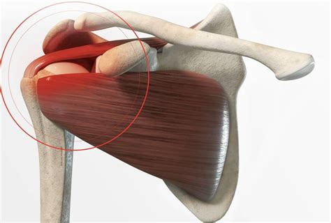 Droit du travail les conséquences d une fissure du tendon de l épaule