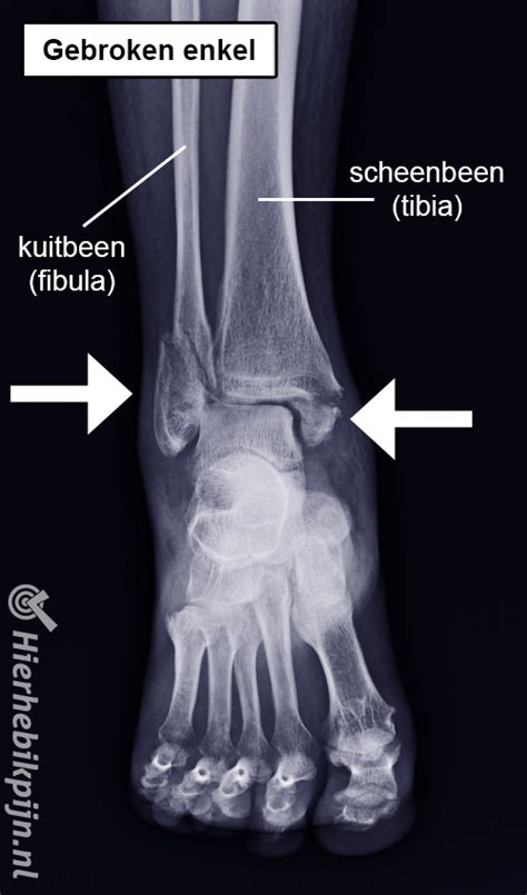 Gebroken Enkel Fracturen Hier Heb Ik Pijn