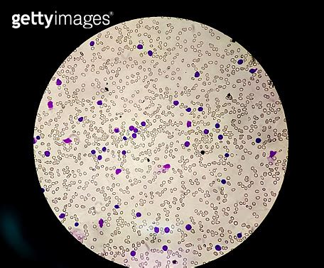 Blood Smear Leishman Stained Microscopic X Show Acute Lymphocytic