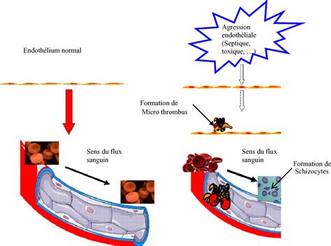 Microangiopathie Thrombotique Shu