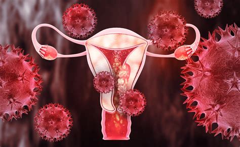 Endometrial Cancer A New Treatment Approved In France Ace Mind