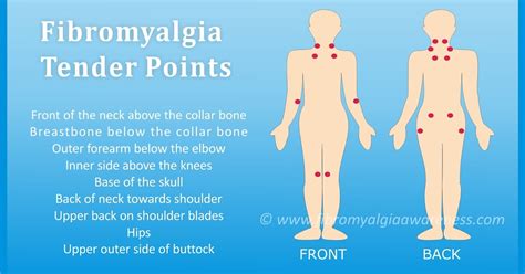 Pressure Points With Fibromyalgia