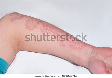 Psoriasis Lesion Arms Photos Images And Pictures Shutterstock