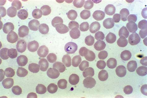 Imagen Gratis Microfotografía Muestra De Sangre El Plasmodium Falciparum Anillos Eritrocitos