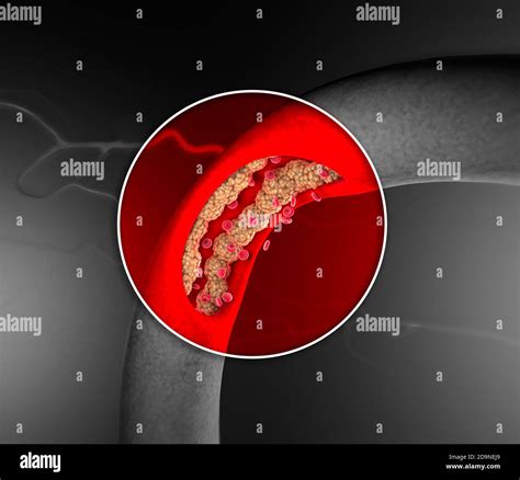 Cholesterol Formation Fat Artery Vein Heart Red Blood Cells Blood