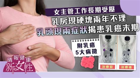 健康新女性｜女主管工作長期受壓 乳房現硬塊兩年不理 乳頭現兩症狀揭患乳癌末期 晴報 健康 腫瘤及癌症 D231015