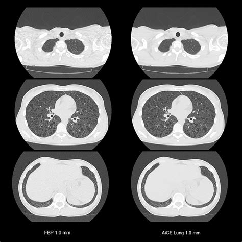 what is lam disease What is lam disease also known as ...