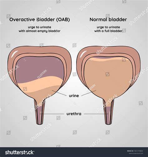 Urinary Incontinence Normal Bladder: Over 52 Royalty-Free Licensable ...