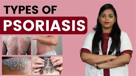 Main Types Of Psoriasis Explained In Detail By Dr Kanchan Singh