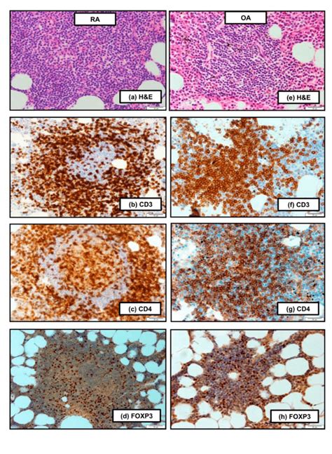 Histopathological Features Of The Bone Marrow Bm Of Patients With