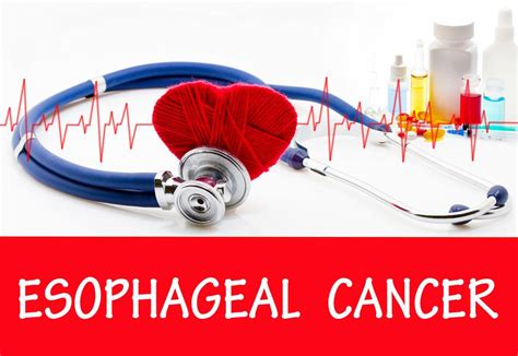 Esophageal Cancer – Causes, Symptoms And Risk Factors