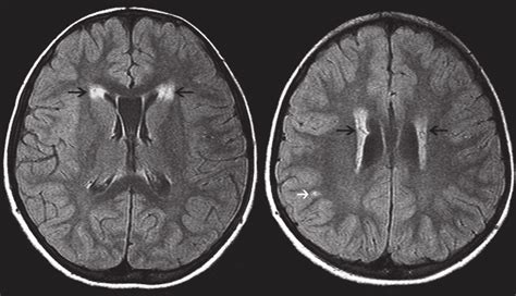 Axial Flair Image Showing Symmetrical High Signal Intensity Download Scientific Diagram