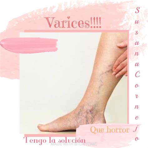 Las Varices Nuestro Terror Las Varices Son Venas Hinchadas Y