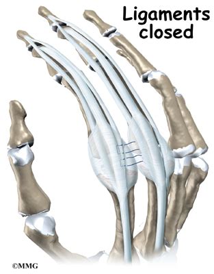 Artificial Joint Replacement of the Finger | eOrthopod.com