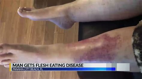 Georgia Man Gets Flesh Eating Disease After Trip To Panama City Beach