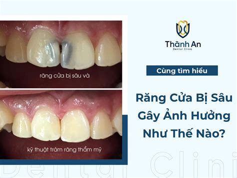 rang cua bi sau gay anh huong nhu  nao phai lam sao