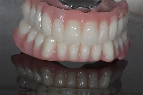 Dental Implant Retained Denture Leeds Securing Your Teeth