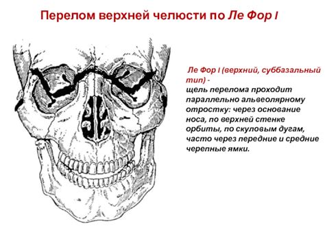 Тема Перелом верхней челюсти Классификация клиника диагностика