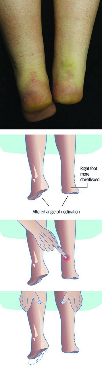 Torn Achilles Tendon Symptoms