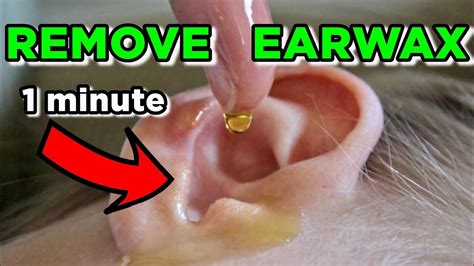 How To Get Rid Of Earwax At Home Safely In 1 Minute Youtube