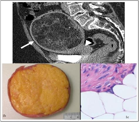 An Impressive Uterine Mass A Case Of A Lipoleiomyoma Journal Of